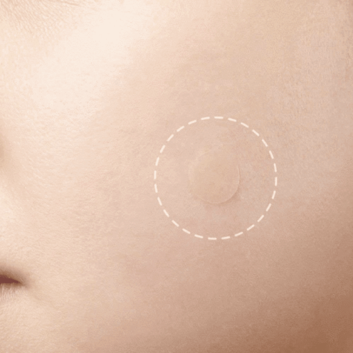 Skin Tag Removal Treatment Patch