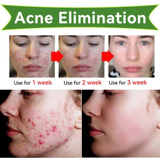 Acne Removal Acne Scar Cream Pore Size Reduction And Oil Control Herbal Acne Cream