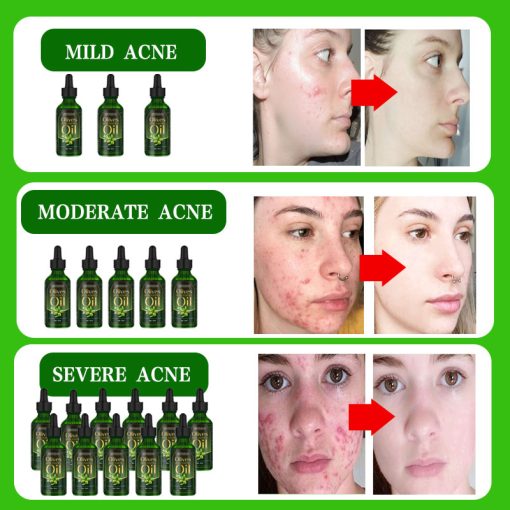 Acne Removal Acne Scar Cream Pore Size Reduction And Oil Control Herbal Acne Cream