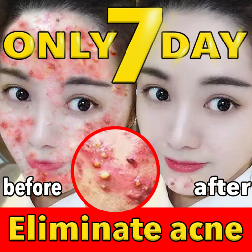 Acne Removal Acne Scar Cream Pore Size Reduction And Oil Control Herbal Acne Cream