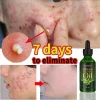 Acne Removal Acne Scar Cream Pore Size Reduction And Oil Control Herbal Acne Cream