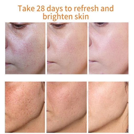 Effective Whitening Freckle Cream Remove Melasma Acne Spot Pigment Melanin Dark Spots Pigmentation Moisturizing Gel Skin Care