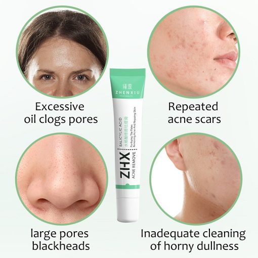 Salicylic Acid Acne Cream Remove Blackhead Oil Control Anti-Acne Treatment Repair Pimple Acne Scar Whitening Face Cream Skincare