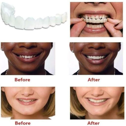 Teeth Veneer Silicone Top & Bottom