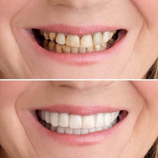 Teeth Veneer Silicone Top & Bottom4